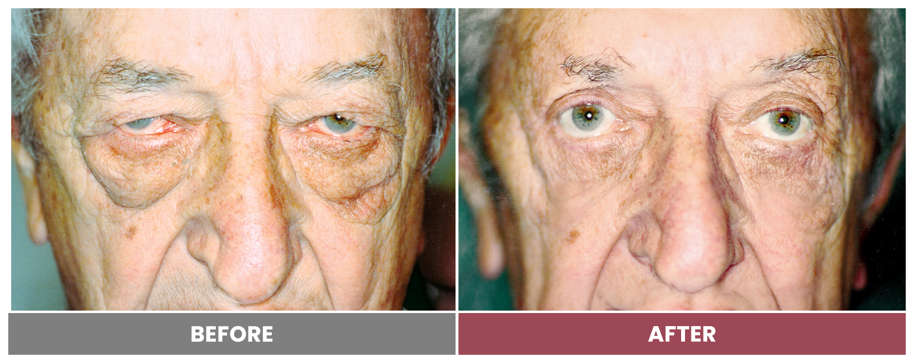Upper Blepharoplasty - Case 60